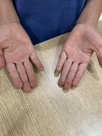 9歲小學(xué)生長(zhǎng)期拍煙卡，手部粗糙長(zhǎng)繭。受訪(fǎng)者供圖